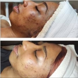 Acne Bootcamp at Majestic Moodz Skincare in Louisville, KY